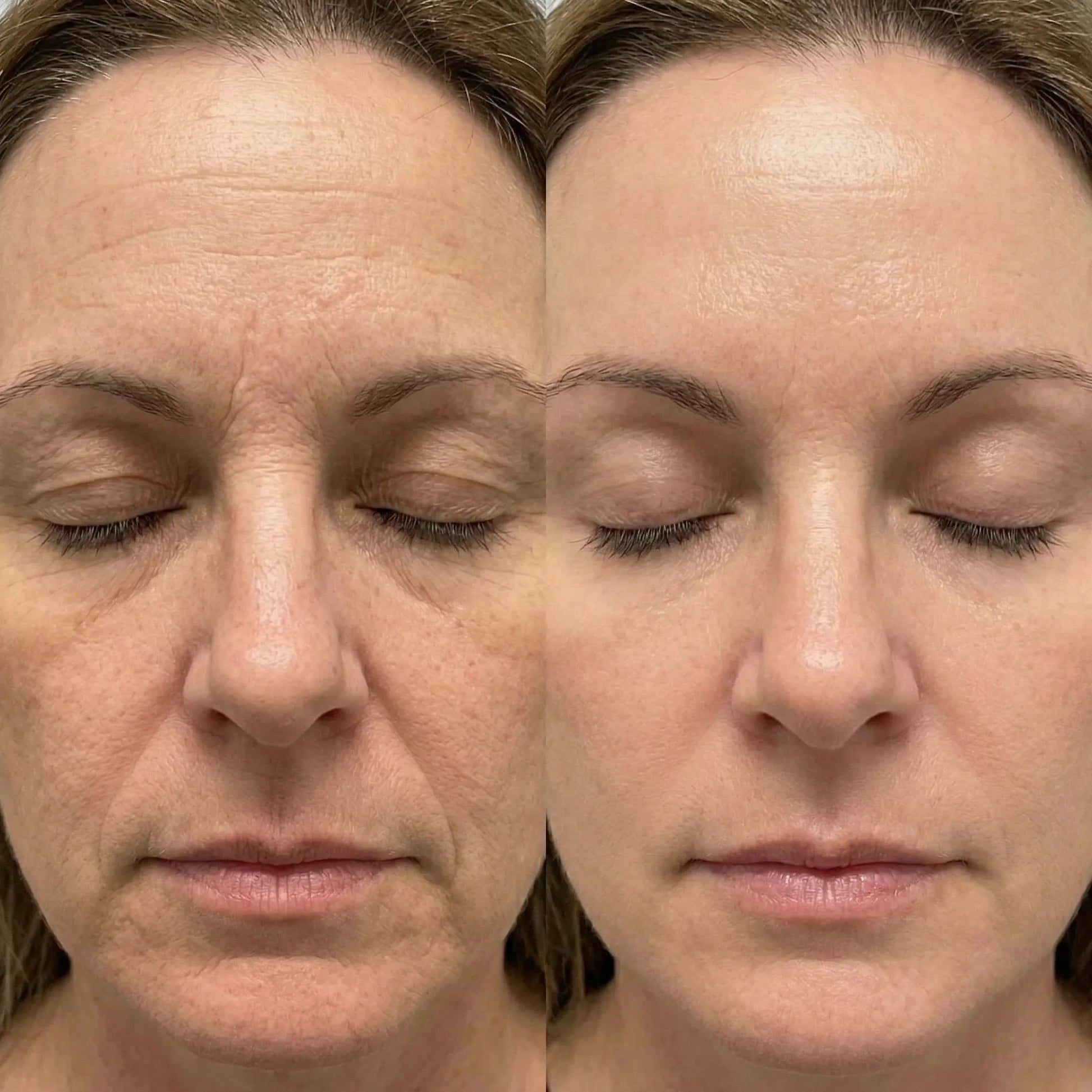 Before and after comparison of a woman's face showing reduced wrinkles and smoother skin, QueenSkin effect