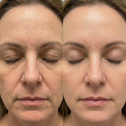 Before and after comparison of a woman's face showing reduced wrinkles and smoother skin, QueenSkin effect