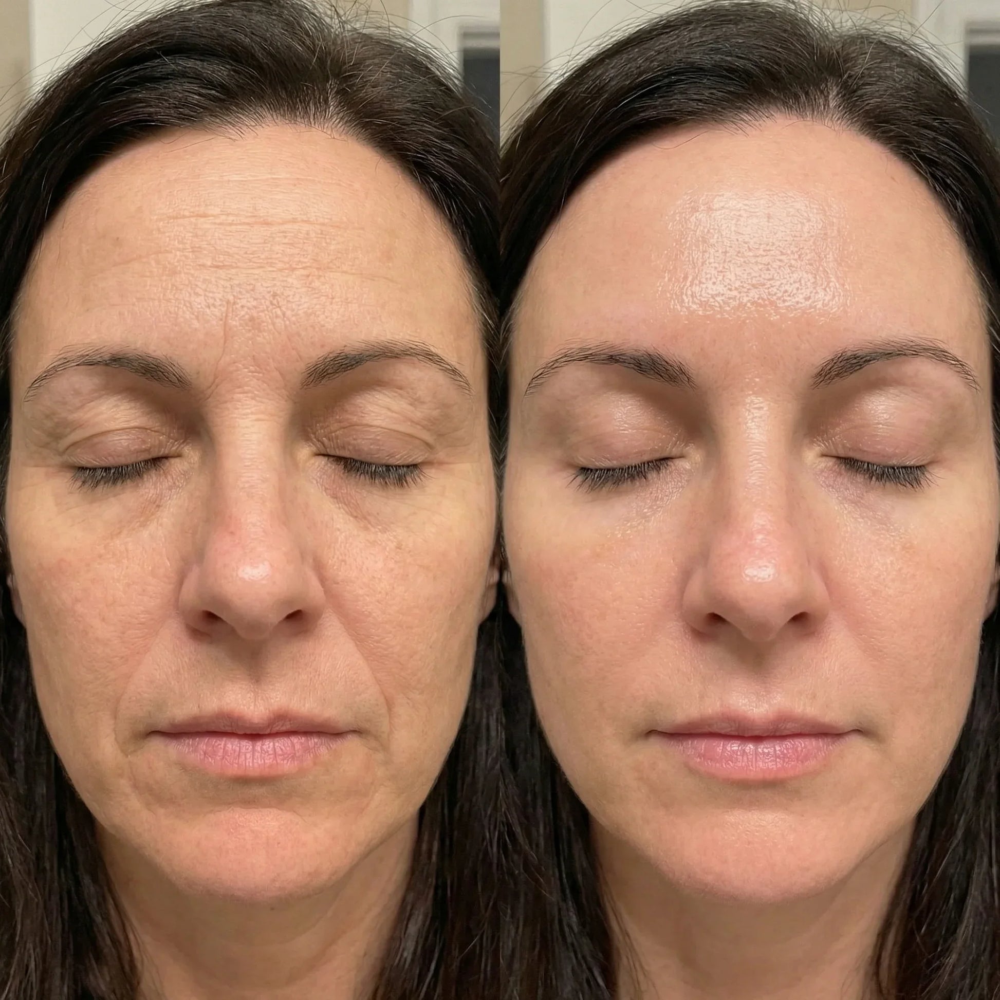 QueenSkin before and after results, reduced wrinkles and smoother, hydrated skin in comparison photos