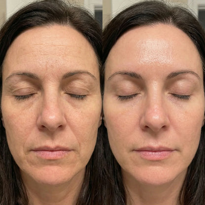 QueenSkin before and after results, reduced wrinkles and smoother, hydrated skin in comparison photos